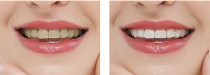 Whiten & Clean: All-in-One Teeth Care Set 🦷